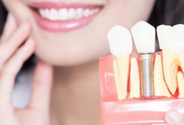 implants dentaires